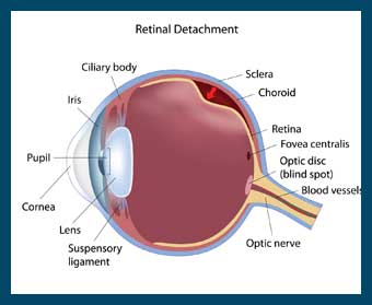 Retinal Tears and Detachment
